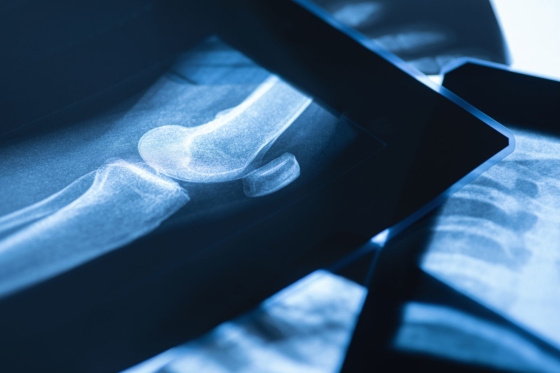 Lateral knee X-ray β orthopedic specialty diagnostics