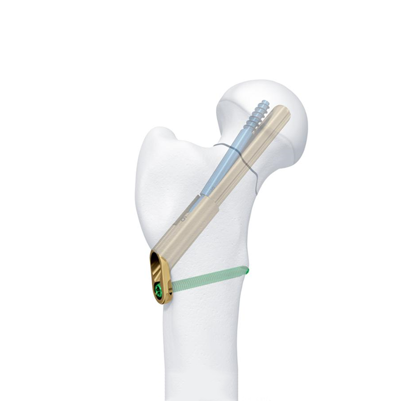 fns femoral neck system